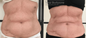 Før og efter vægttab billeder